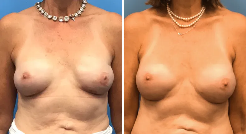 Before and after breast reconstruction: patient's breasts
