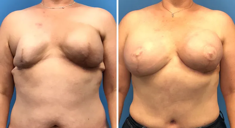 Before and after breast reconstruction: woman's breasts
