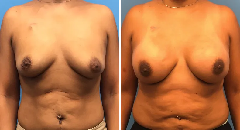 Before and after breast reconstruction: woman's breasts from the front