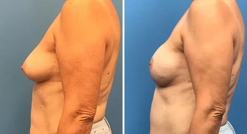 Before and after breast reconstruction: woman's breasts from the left side