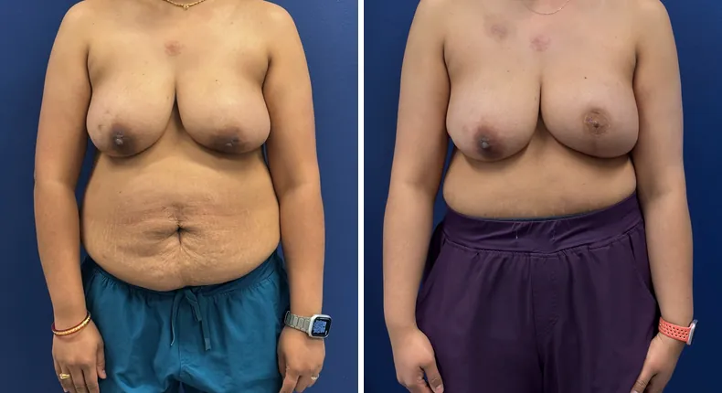 Before and after breast reconstruction: woman's breasts