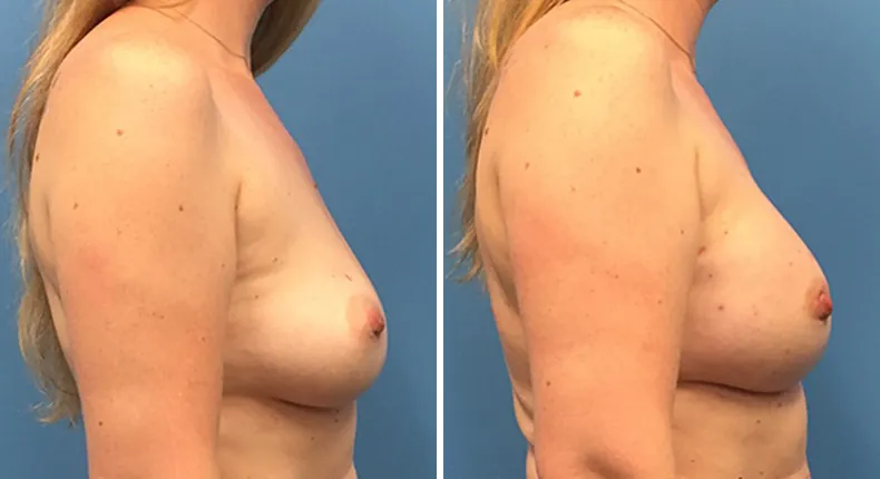 Before and after breast reconstruction: woman's breasts from the right side