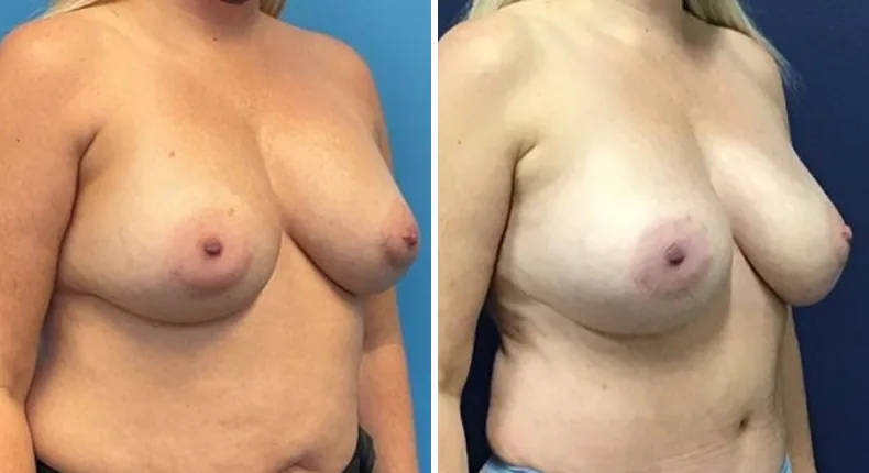 Before and after breast reconstruction: patient's breasts at a right angle