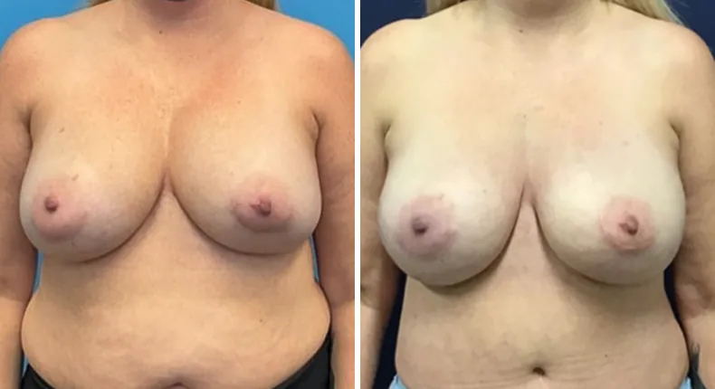 Before and after breast reconstruction: patient's breasts from the front