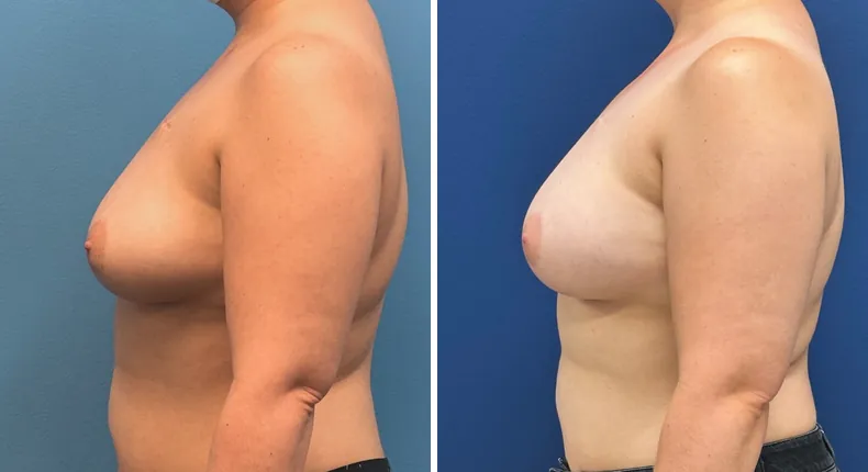 Before and after breast reconstruction: patient's breasts from the left side
