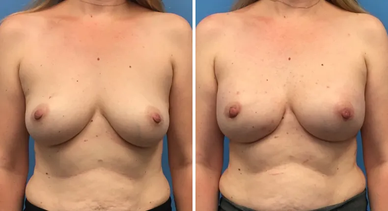 Before and after breast reconstruction: patient's breasts