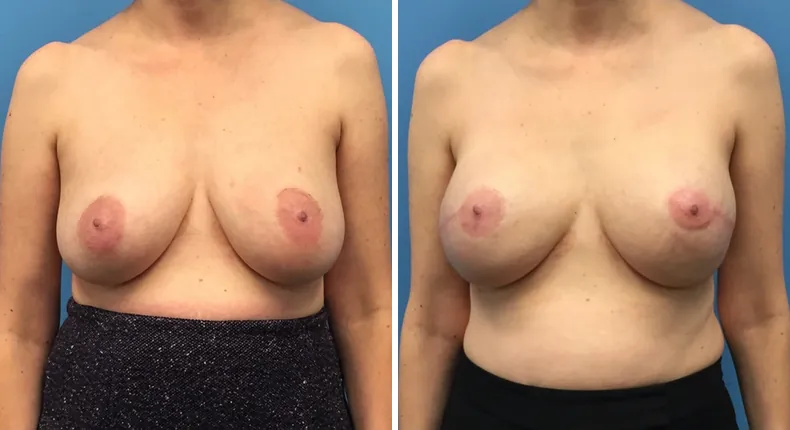 Before and after breast reconstruction: patient's breasts