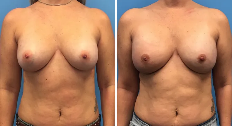 Before and after breast reconstruction: woman's breasts