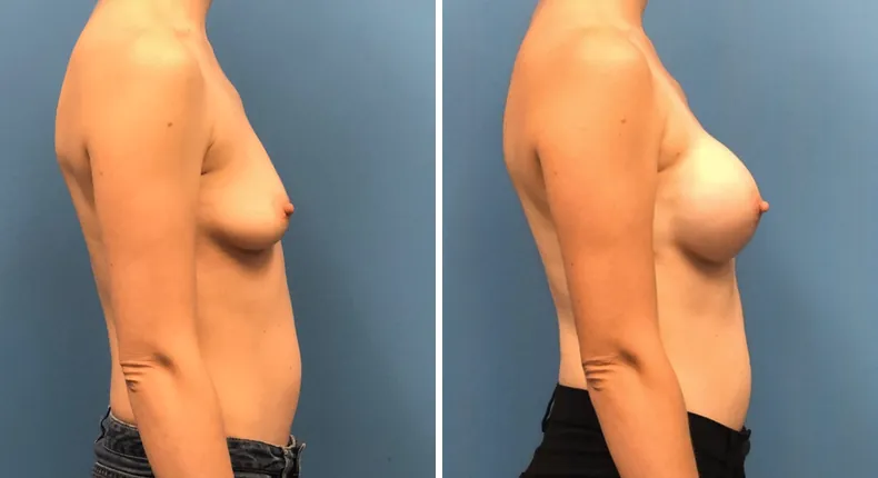 Before and after breast reconstruction: patient's breasts from the right side