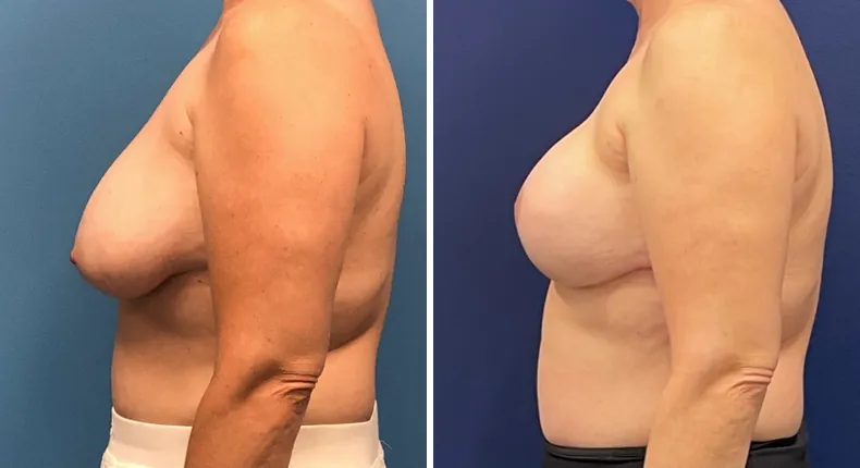 Before and after breast reconstruction: patient's breasts from the left side