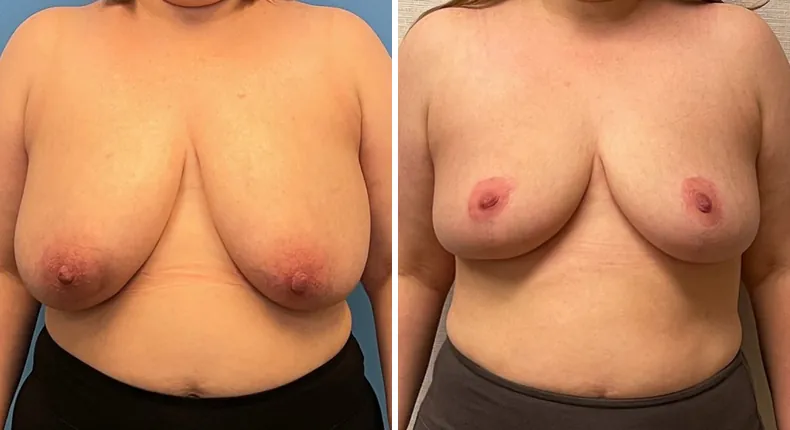 Before and after breast reconstruction: patient's breasts