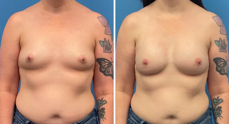 Before and after breast reconstruction: patient's breasts