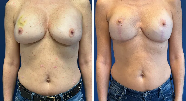 Before and after breast reconstruction: patient's breasts