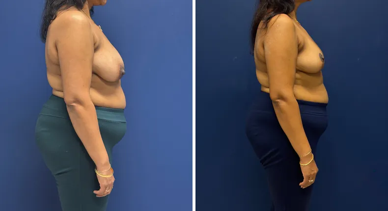 Before and after breast reconstruction: patient's breasts