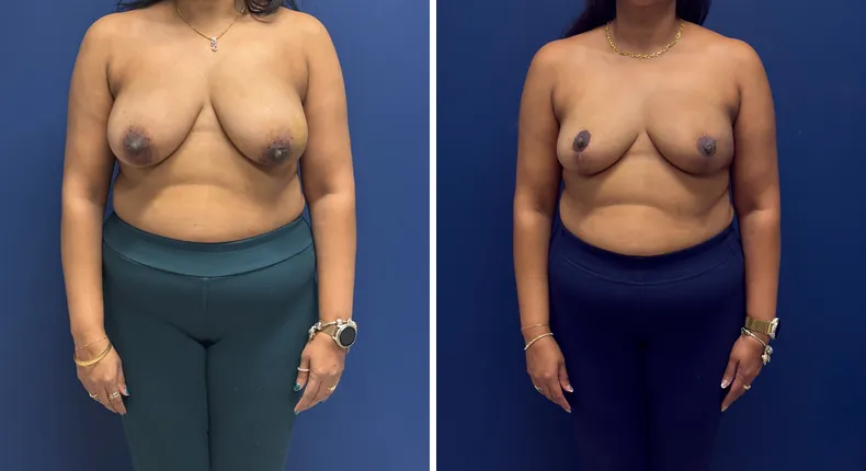 Before and after breast reconstruction: patient's breasts