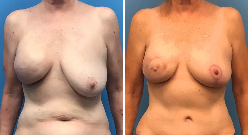 Before and after breast reconstruction: woman's breasts from the front