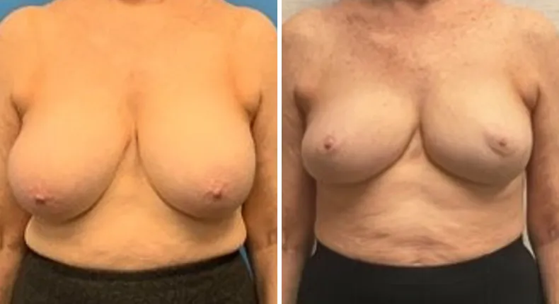 Before and after breast reconstruction: patient's breasts from the front