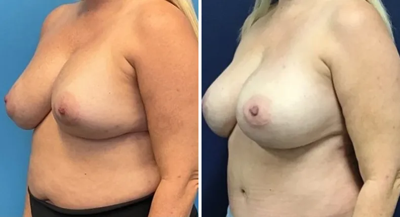 Before and after breast reconstruction: patient's breasts at a left angle