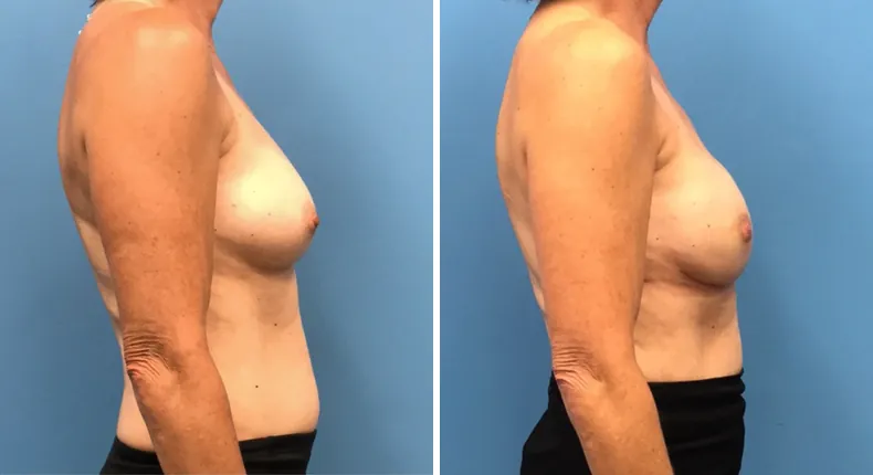 Before and after breast reconstruction: patient's breasts from the right side