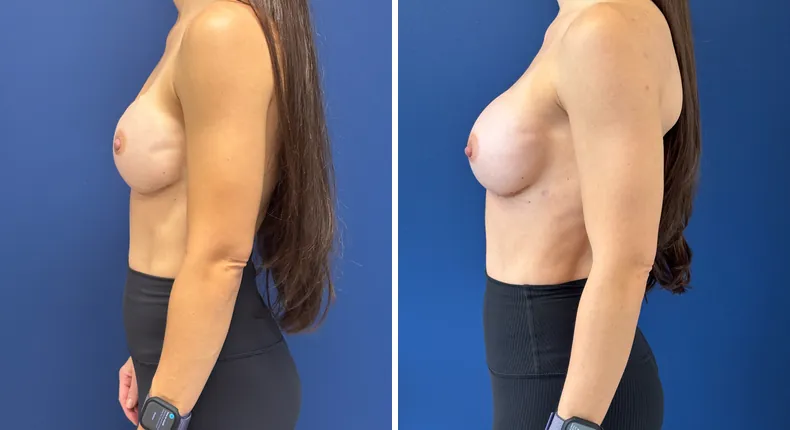 Before and after breast reconstruction: woman's breasts from the left side