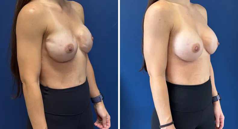 Before and after breast reconstruction: woman's breasts at a right angle