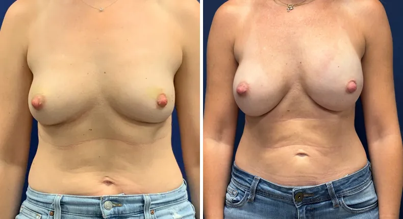 Before and after breast reconstruction: patient's breasts