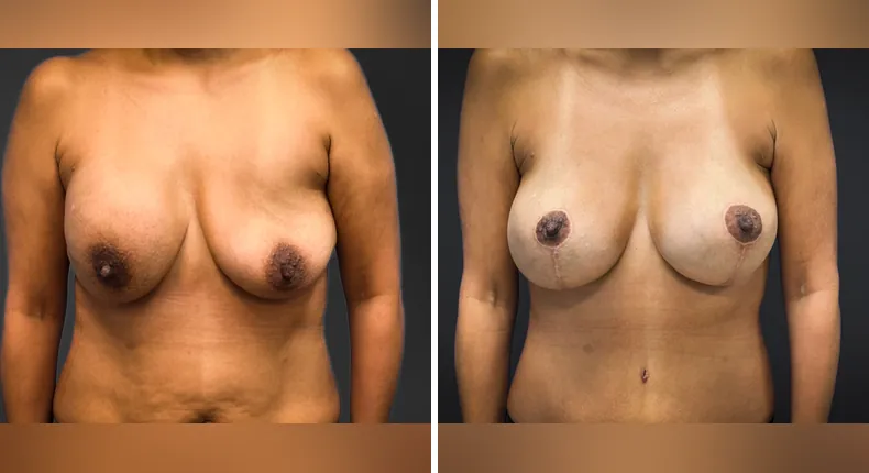 Before and after breast reconstruction: patient's breasts from the front