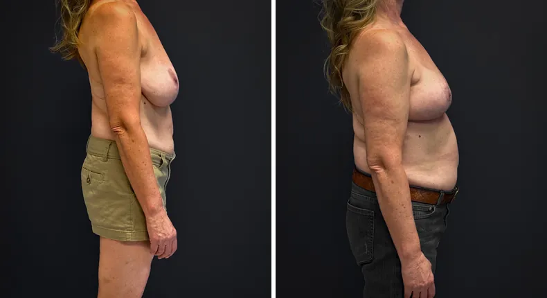Before and after breast reconstruction: patient's breasts from the right side