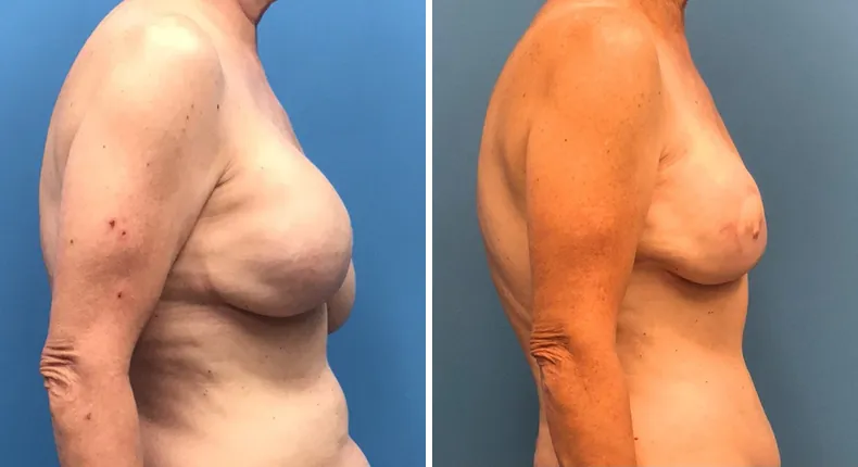 Before and after breast reconstruction: woman's breasts from the right side