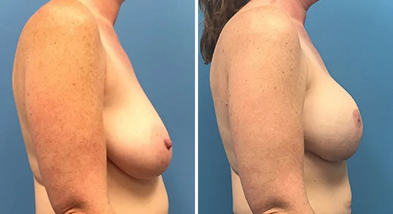 Before and after breast reconstruction: woman's breasts from the right side