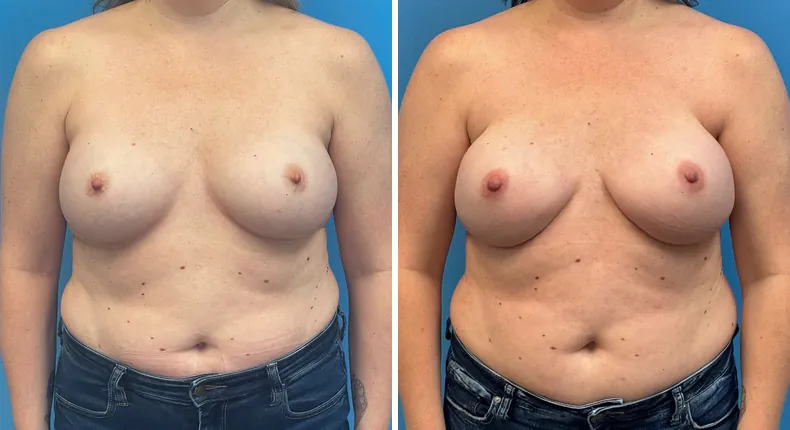 Before and after breast reconstruction: patient's breasts from the front