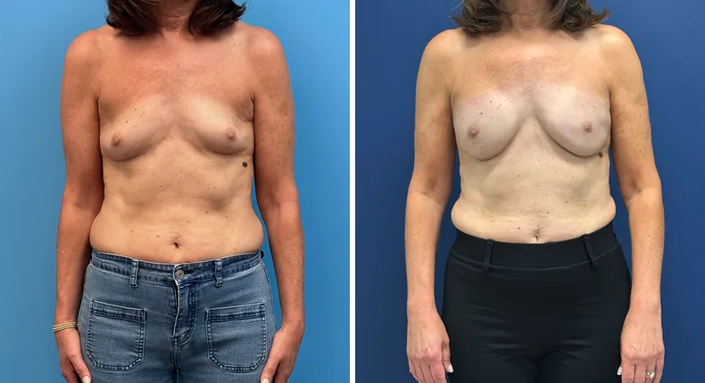 Before and after breast reconstruction: woman's breasts from the front