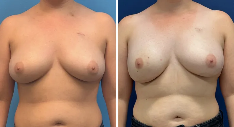 Before and after breast reconstruction: patient's breasts from the front