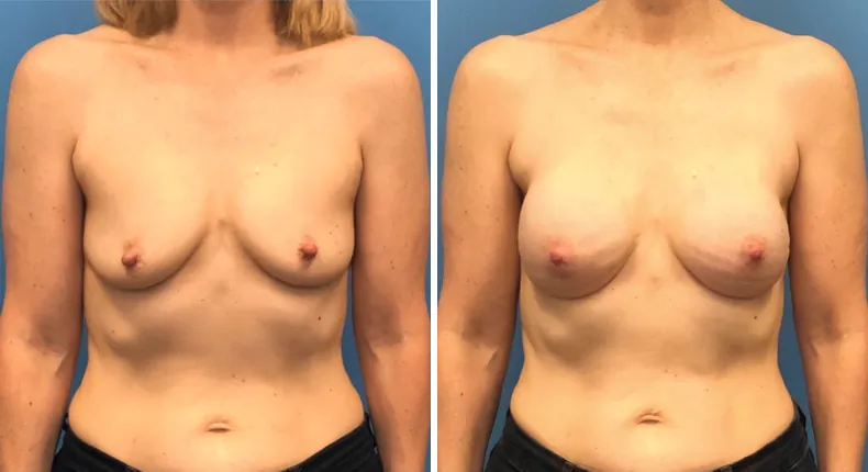 Before and after breast reconstruction: patient's breasts