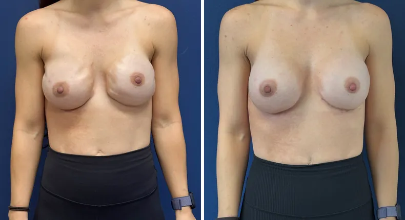 Before and after breast reconstruction: woman's breasts
