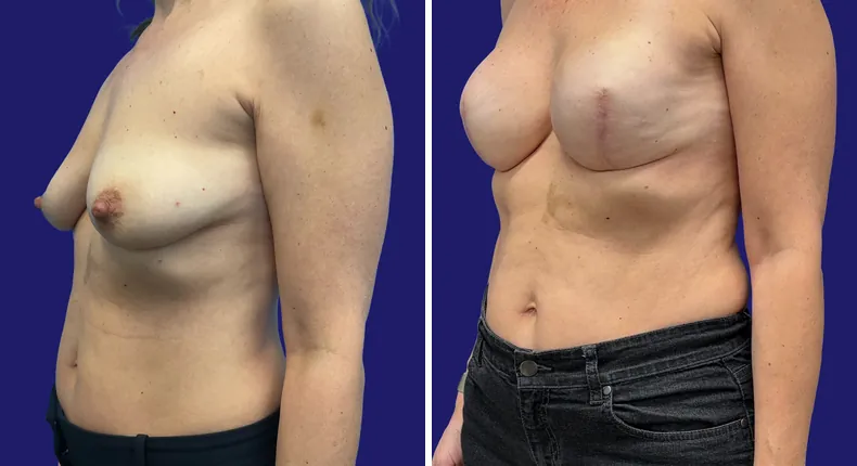 Before and after breast reconstruction: woman's breasts
