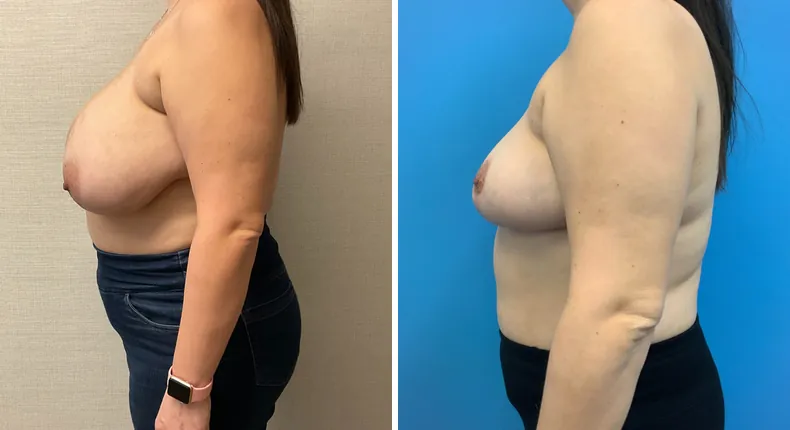 Before and after breast reconstruction: patient's breasts in left profile