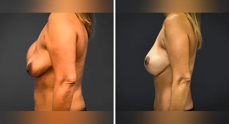 Before and after breast reconstruction: patient's breasts from the left side