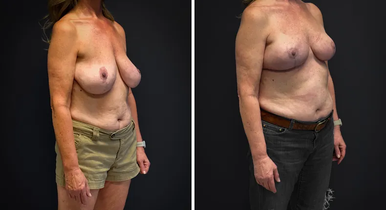 Before and after breast reconstruction: patient's breasts from the right side