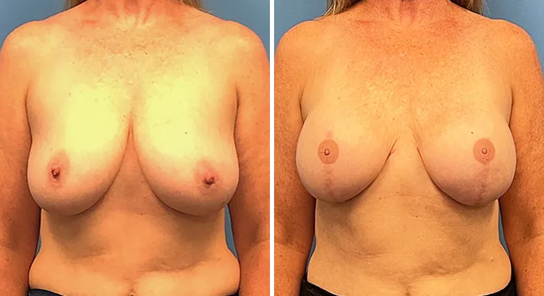 Before and after breast reconstruction: woman's breasts from the front
