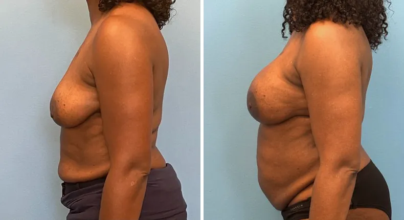 Before and after breast reconstruction: patient's breasts from the left side