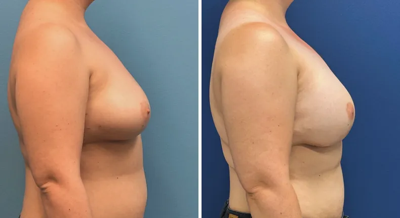 Before and after breast reconstruction: patient's breasts from the right side