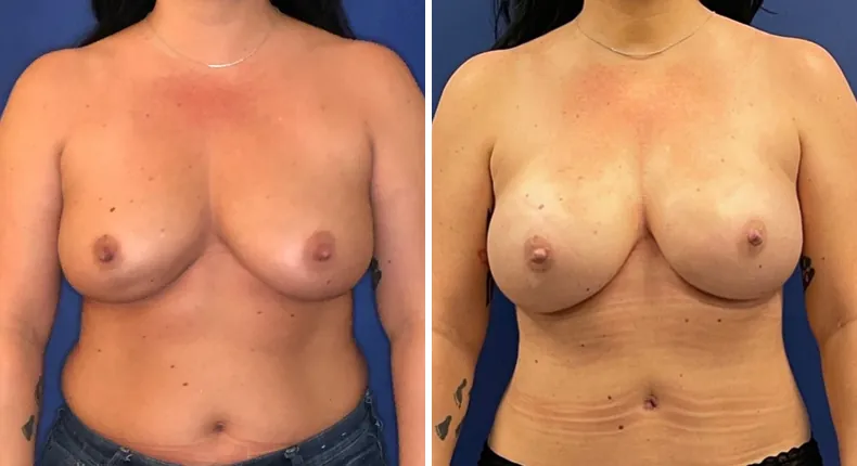 Before and after breast reconstruction: woman's breasts