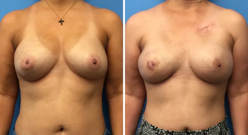 Before and after breast reconstruction: patient's breasts