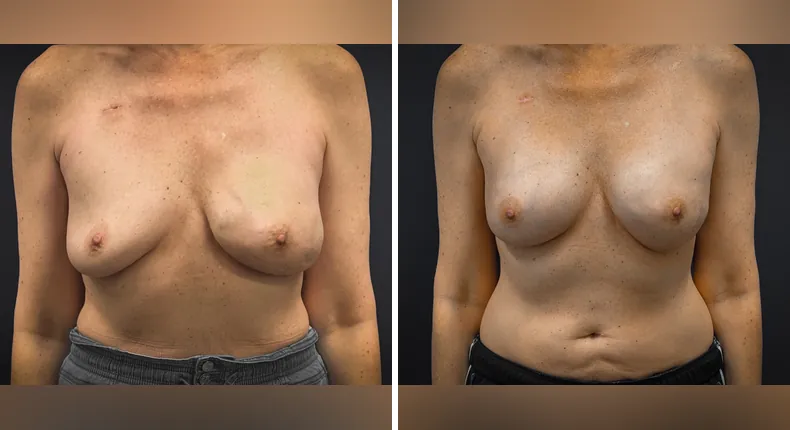 Before and after breast reconstruction: patient's breasts