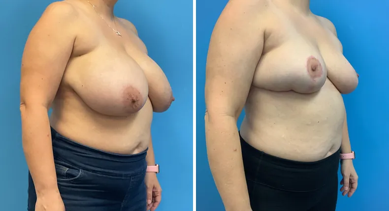 Before and after breast reconstruction: patient's breasts from the right side