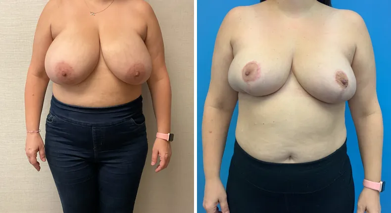 Before and after breast reconstruction: patient's breasts