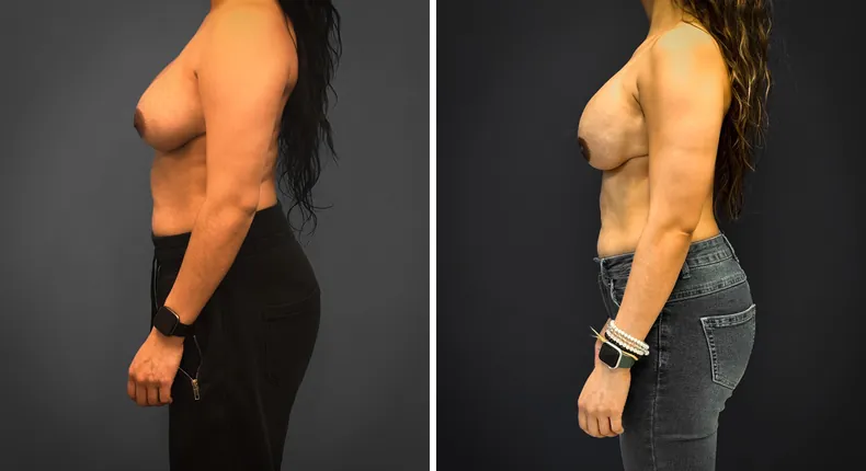 Before and after breast reconstruction: patient's breasts from the left side
