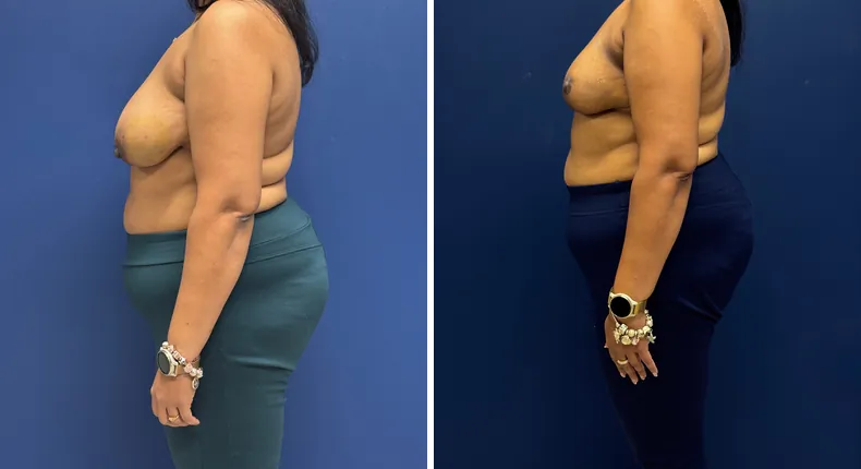 Before and after breast reconstruction: patient's breasts