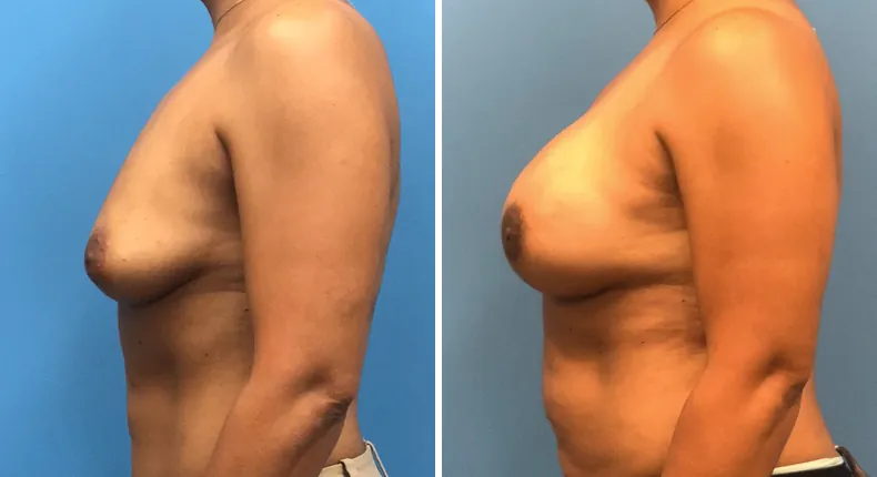 Before and after breast reconstruction: woman's breasts from the left side